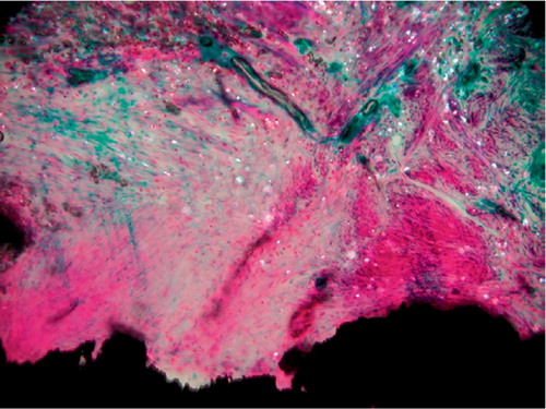 Figure 7. Unstable PO implant. MMA section with the implant stained in situ with basic fuchsin and light green. Polarized light microscopy, 200 × Microscopic field of the fibrous membrane at zone 4. Multiple PE particles are scattered in the tissue. Note the absence of fibro-cartilage and bone.