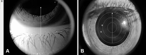Figure 4 Infrared images showing AS-OCT scan positions; (A) vertical line scan at the 6 o’clock position of the lower lid-corneal junction to detect the lower tear meniscus (TM) in the right eye of a group A patient; (B) scan positions to measure corneal total and epithelial thickness in the central 6 mm zone in the left eye of a group B patient.