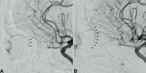 Figure 4 Left internal carotid artery cranial diffusion subtraction angiography images before and after tPA thrombolysis for CRAO. Lateral view shows minimal but present retinal blush (black arrows) before tPA injection (A). After tPA injection, improvement of the retinal blush (black arrows) is observed (B).