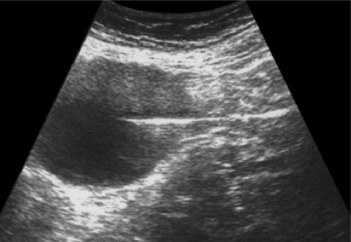Figure 3 Ultrasound scan after withdrawal of the needle.