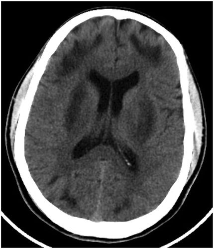 Figure 1. Case 1 brain CT Showing hypodense confluent lesions in superficial white matter and putamen consistent with acute toxic edema and infarction.