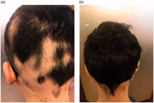 Figure 1. Explicative photographic images of a subject from Group I before (A) and after (B) the treatment.