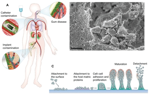 Figure 1 Biofilm pathogenicity in humans is mediated by dissemination and biofilm matrix formation. (A) Possible routes of biofilm dissemination around the body originating from sites such as gum disease, catheter, or implant contamination.Citation12 (B) Scanning electron micrographs (SEM) of biofilm matrix, offering protection of resident bacteria from eradication, imaged from a clinical endotracheal tube identified as Streptococcus pneumonia. Scale bar shown is 1 μm. (C) Schematic of biofilm-mediated device-related infection, starting with bacterial attachment to a device or adsorbed host proteins, leading to biopolymer mediated cell–cell adhesion, maturation, and eventual detachment leading to the spread of infection.Citation66Note: A is reproduced from Hall-Stoodley et alCitation12 and C is reproduced from OttoCitation66 with permission from the publishers.