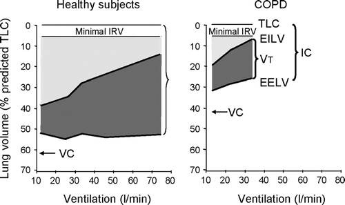 Figure 3 Operational lung volumes as ventilation increases during exercise in COPD patients and in age-matched healthy subjects. Used with permission from O'Donnell et al. AJRCCM 2001; 164:770–777.
