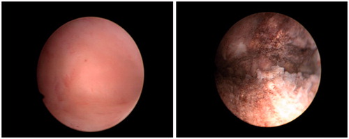 Figure 1. A hysteroscopic view of the endometrial cavity prior to (left) and after (right) NovaSure® endometrial ablation.