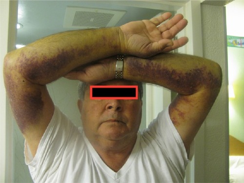 Figure 1 Bleeding associated with acquired hemophilia A.