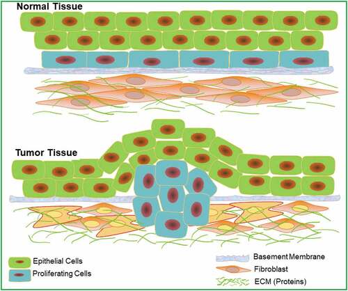 Figure 1. Schematic of healthy and diseased tissues. The BM serves as a structural barrier to cancer cell invasion, intravasation, and extravasation derived from [Citation14].
