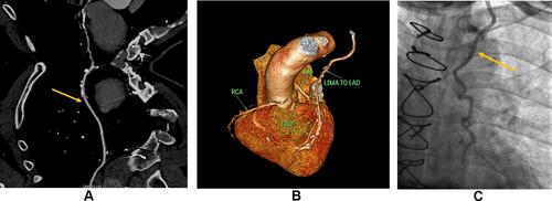 Figure 6 Male patient, 60 y old, complains of unstable angina post-CABG, referred from a cardiologist for CCTA. (A) CPR image of LIMA-LAD graft; Shows patency of the graft body till its anastomotic sites (Yellow arrow). (B) VR 3D reconstruction demonstrates; Shows patency of LIMA-LAD graft body till anastomotic site and patent RCA. (C) ICA image; Confirms patency of LIMA-LAD graft (Yellow arrow). Diagnosis CAD RADS 0/G.