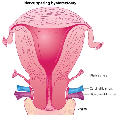 Figure 2 Vertical presentation nerve sparing hysterectomy.