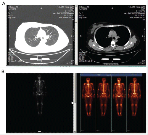 Figure 3. Computed tomography (CT) and bone scan of the patient. A, CT of the thorax showed no evidence of disease elsewhere. B, Bone scan were normal.