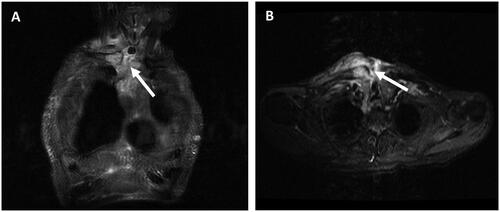 Figure 2. (A) Coronal and (B) Axial T2 with fat saturation shows suppurative collection adjacent to the tracheostomy and a fistulous path (arrows) between the referred liquid collection and the sternoclavicular joint effusion, in the plane immediately above the notch sternal.