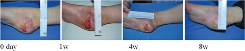 Figure 2. Ding Jiasheng, male, 55 years old, suffered from skin ulceration of the right heel with infection. The infection was recurrent and uncured for more than 3 months. The healing rate was 99% after 8 weeks of ADSC treatment.