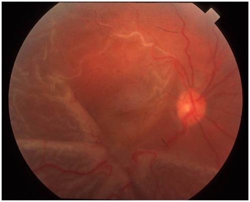 Figure 2 Fundus photograph showing a star fold from a proliferative vitreoretinopathy in a patient with a history of a retinal detachment.