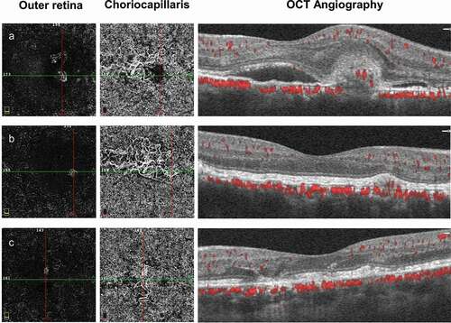 Figure 3. Follow-up of optical coherence tomography angiography (OCTA). (a) OCTA showed choroidal neovascularization in the outer retina layer, and enlarged and tangled vessels in the choriocapillaris layer in the right eye. (b) Regression of CNV in the outer retina layer, but remained in the choriocapillaris layer. (c) Enlarged and tangled vessels in the choriocapillaris layer in the left eye