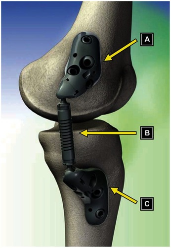 Figure 1 Components of the KineSpring® Knee Implant System (Moximed, Inc, Hayward, CA, USA). (A) Femoral base, (B) absorber unit, (C) tibial base.