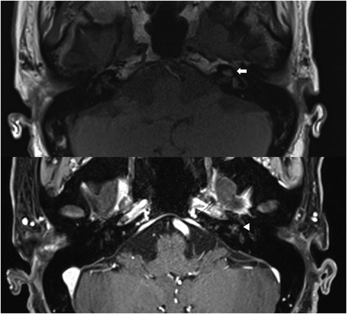 Figure 2. On temporal magnetic resonance imaging, an abnormal hyperintense lesion was observed at the left cochlea and vestibule on T1-weighted imaging (arrow) (a), which was not enhanced on T1-weighted imaging with contrast (arrowhead) (b).