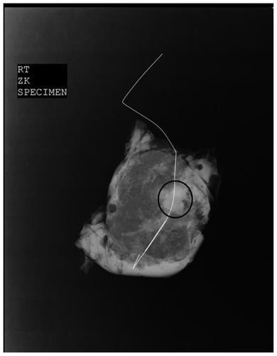 Figure 2 Magnified view of excised breast specimen showing the localized soft tissue density nodule (Black Circle) with Kopan’s wire in situ.