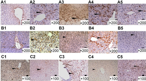 Figure 5 Immunohistochemical stainings of TIMP-2 (A1–A5 Scale bar: 50 μm), TGF-β1 (B1–B5 Scale bar: 50 μm), and MMP-2 (C1–C5 Scale bar: 100 μm) in the livers of diabetic rats before and after L6H4 treatment. Expression of TGF-β1 and TIMP-2 was significantly increased in the liver tissue of the rats in the HF and DM group (Black arrowhead in A2 and A4, B2 and B4), which was decreased in rats treated with L6H4 (Black arrowhead in A3 and A5, B3 and B5). MMP-2 expression decreased in the level of the HF and DM group (C2 and C4), enhanced after the L6H4 invention (C3 and C5).