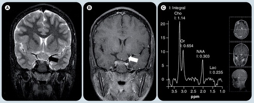 Figure 6. A neurofibromatosis type I patient with chiasmatic glioma.(A) Coronal T2-weighted image and (B) postcontrast T1-weighted image shows a well defined nonenhancing mass in the chiasm (arrows). (C) Single voxel MR spectroscopy placed on this lesion shows increased Cho peak and decreased NAA peak, implying high cellularity nature of the glioma. A small Lac is typical of pilocytic gliomas, which use glucose exclusively as their source of energy.Cho: Choline; Lac: Lactate; NAA: N-acetyl aspartate; Or: .