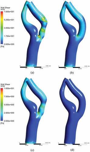 Figure 13. Wall shear stress (WSS) distribution: (a) near peak systole model, (b) near peak systole stented model (c) peak diastole stenosed model, (d) peak diastole stented model.