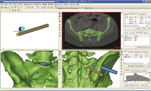Figure 2. Simulated creation of the working corridor. The blue cylinder (10 mm in diameter) represents the working corridor and the brown cylinder (7.5 mm in diameter) represents the S1 pedicle screw. The working corridor started from the right ilium and proceeded into the center of the lumbosacral disc. The position and direction of the corridor could be adjusted to keep it within the safe zone, i.e., avoiding penetration of the spinal canal or the anterior or upper sacral wall. Feasibility would be verified if both the working corridor and the S1 pedicle screw could be accommodated in the sacral ala without overlapping and without penetrating either the spinal canal or anterior or upper sacral wall. The arrow points to the interspace between the corridor and the screw trajectory, which demonstrates that there is no overlap.