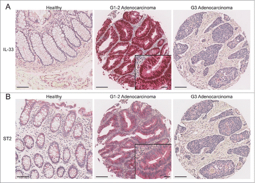 Figure 1. Representative picture of TMA cores showing healthy mucosa, low-grade and high-grade adenocarcinomas, respectively. Sections were stained for (A) IL-33 or (B) ST2. Scale bars: overview: 100 µm; inlay 25 µm.