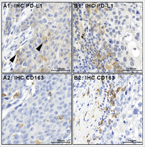 Figure 2. Tumor-associated PD-L1-positive immune cells stain positive for macrophage marker proteins. PD-L1-positive immune cells (black arrow heads) were encountered in combination with PD-L1-positive tumor cells (A1) or as the only PD-L1-positive cell population (B1). In all cases, PD-L1 was positive in immune cells that were also positive for macrophage marker proteins CD163 (A2, B2) and CD68 (Figs. S1, 2).