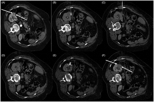Figure 1. RFA of a right renal tumor adjacent to the right colon. Before the treatment, hydrodissection has been obtained in order to reduce the risk of bowel damage and perforation. (A) Contrast-enhanced CT demonstrating the enhancing tumor in the right kidney (white arrows). (B–D) A spinal needle has been inserted and dextrose 5% has been infused for hydrodissection. (E) An umbrella-like RF electrode has been inserted in the lesion. (F) Post ablation necrotic zone (white arrows) has covered the whole lesion with no damage to the adjacent colon.
