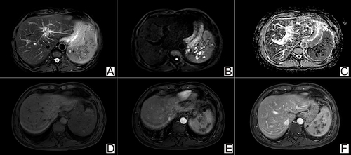 Figure 1 Abdominal MR enhancement scan of chronic splenic melioidosis. There were multiple focal lesions with indistinct margin. They demonstrated hypointensity on T2WI (A), hyperintensity on DWI (B), and decreased ADC value (C), indicating restricted diffusion. Dynamic contrast-enhanced T1-weighted images showed mild progressive enhancement (D–F).
