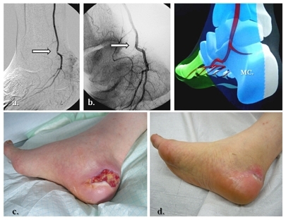 Figure 8 Specific posterior tibial and adjacent medial calcaneal artery angiosome revascularization in heel related wound. (a) Tight stenosis in the distal posterior tibial artery, above emergence of the medial calcaneal branch, (b) Angiographic result after selective angioplasty, (c) initial presentation of heel ulcer, and (d) clinical results after 5 weeks of team surveillance.
