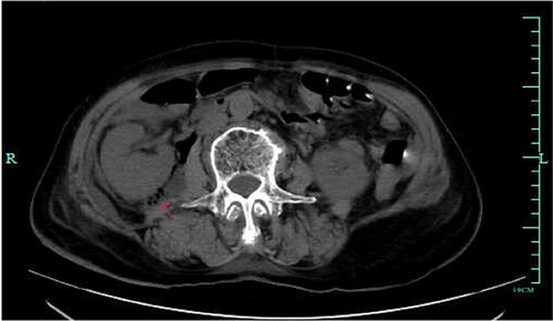 Figure 1 Images of abdomen computed tomography (CT). Free air was observed around the right retroperitoneal area (indicated by red arrows).