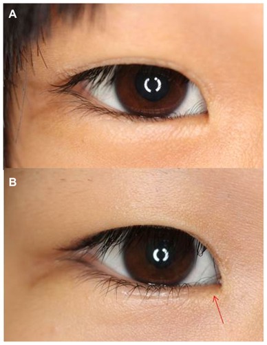 Figure 3 Hotz alone case.