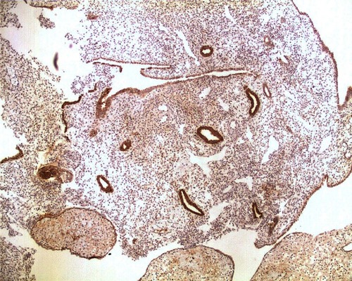 Figure 3 Aromatase expression in both the atrophic endometrial glands and decidual stroma, in a patient with idiopathic menorrhagia who was experiencing breakthrough bleeding during the use of an oral contraceptive containing drospirenone in an extended regimen.