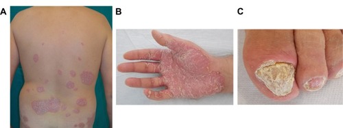 Figure 1 Clinical manifestations of psoriasis.