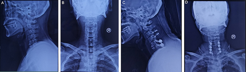 Figure 4 Preoperative X-ray. Lateral (A) and anteroposterior (B) radiographs before surgery show degeneration of the cervical spine and C6–7 vertebral bone destruction. Postoperative X-ray. Lateral (C) and anteroposterior (D) radiographs show C3–T1 instrumentation (posterior).