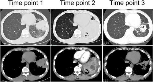 Figure 1 Lung CT manifestation of case 3. Time point 1: At the first visit, clump-like lung consolidation was visible in the left lower lobe, accompanied by the exudation of surrounding ground-glass lesion, and central necrosis was not obvious. Time point 2: At 8 months of onset, large areas of lung consolidation were visible with liquefactive necrosis and small cavities in the lesion. Time point 3: After effective treatment for 3 months, the lesion was significantly smaller with residual cavities and fibrous proliferation lesions.