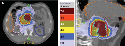 Figure 2. Dose distribution obtained with HT; prescribed dose equal to 44.25 and 52 Gy for 4D-PTV (red color) and 4D-PTV-boost (98.6 cm3; azure color) respectively; patient number 15, axial (A) and sagittal (B) views. Isodose levels are indicated in Gy.