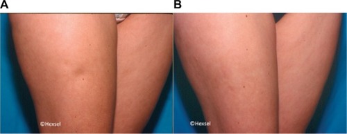 Figure 2 Significant improvement in a right anterolateral thigh cellulite depression before (A) and 30 days after (B) manual subcision.Source: Photo courtesy of Doris Hexsel, MD.