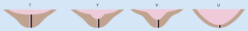 Figure 1. Black lines indicate the correct measurement of cervical length in the different shapes of cervical length: T, Y, V and U.