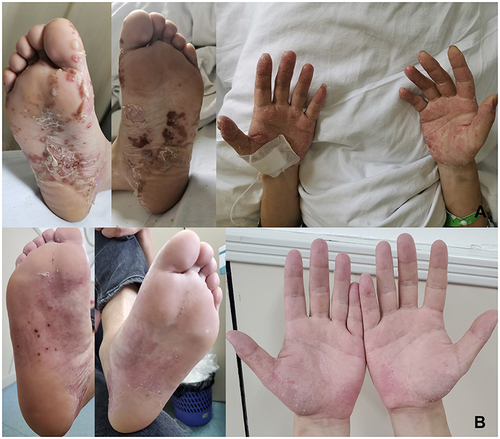 Figure 1 Scattered patchy erythema and pustules on the palms of both hands and the soles (A). The palmoplantar pustules were alleviated after treatment (B).