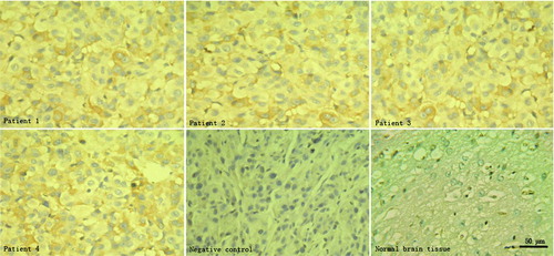 Figure 2  Immunohistochemical analysis of EGFR protein expression in human GBMs. Compared with human normal brain tissues from surgical decompression without EGFR expression, the 4 human GBMs maintain the genetic property of EGFR overexpression. PBS instead of primary antibodies is used as negative controls.