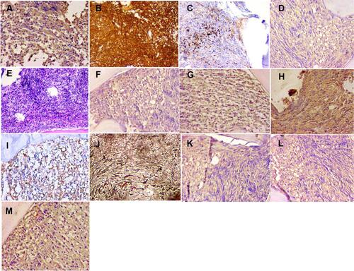 Figure 4 The immunostaining of bone marrow before treatment. (A) (b-FGF;×200), positive; (B) (CD20;×100), positive; (C) (CD61×100), positive; (D) (IL-10;×200), positive; (E) HE 100×; (F) (IL-1β;×200), positive; (G) (PDGF×200), positive; (H) (TGF-β×200), positive; (I) (VEGF×200), positive; (J) reticular fiber staining revealed diffuse fibrosis (MF-3) 100×; (K) (IL-2;×200), positive; (L) (IL-6;×200), positive; (M) (TNF-α×200), positive.