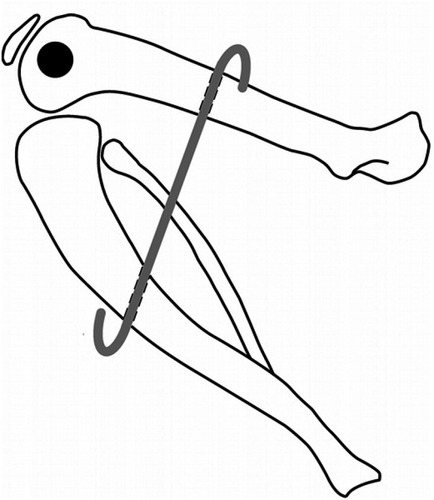 Figure 1 K-wire fixation and immobilization of a knee joint in a 145° flexed position. The black spot reflects the hole in the lateral femoral condyle.