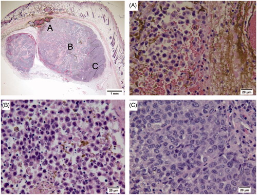 Figure 3. Low magnification (2×, upper left) photomicrograph of a bi-lobed MTGB flank mammary adenocarcinoma treated with mNPH (CEM60) to the centre of the tumour 24 h following treatment. Regions ‘A’ and ‘B’, represented correspondingly by high magnification photomicrographs, demonstrate uniform tumour necrosis. The high magnification photograph of region ‘C’ demonstrates individual cell damage but also significant tumour viability. Regions ‘A’and ‘B’ contained significant mNP/Fe, while region ‘C’ did not.