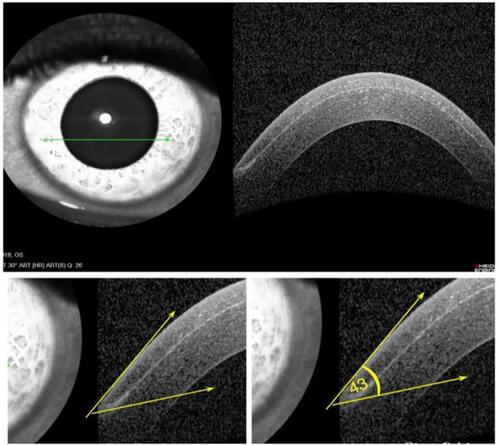 Figure 5 Microkeratome LASIK flap with acute side-cut angle 43°.Abbreviation: LASIK, laser-assisted in situ keratomileusis.