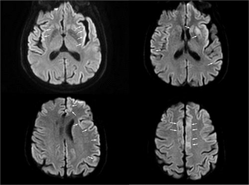 Figure 1. The MRI axial DWI sequence shows signal hyperintensity involving the right frontal, the left frontal and parietal cortical areas (known as cortical ribbon sign); insular cortex (especially on the left) and left corpus striatum are also involved. Areas of interest are highlighted by arrows.