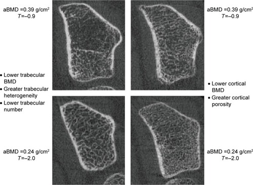 Figure 4 Identical T-scores in bones with different structural features.