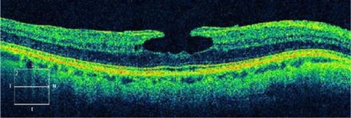 Figure 14 A 59-year-old male with lamellar macular hole.