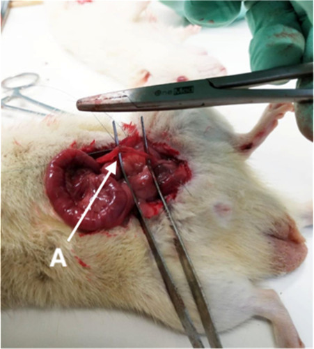 Figure 2 Unilateral UPJO model using Wistar rats. A indicates the left ureter.