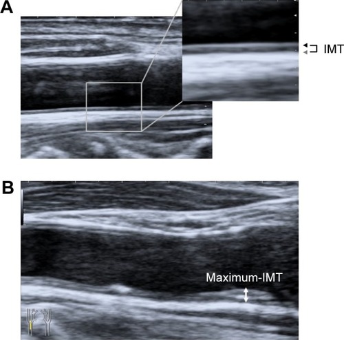Figure 2 Longitudinal B-mode ultrasound image of the common carotid artery.